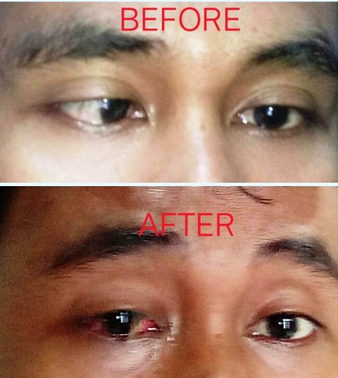 Penampakan bola mata sebelum dan sesudah operasi mata juling I Dokpri